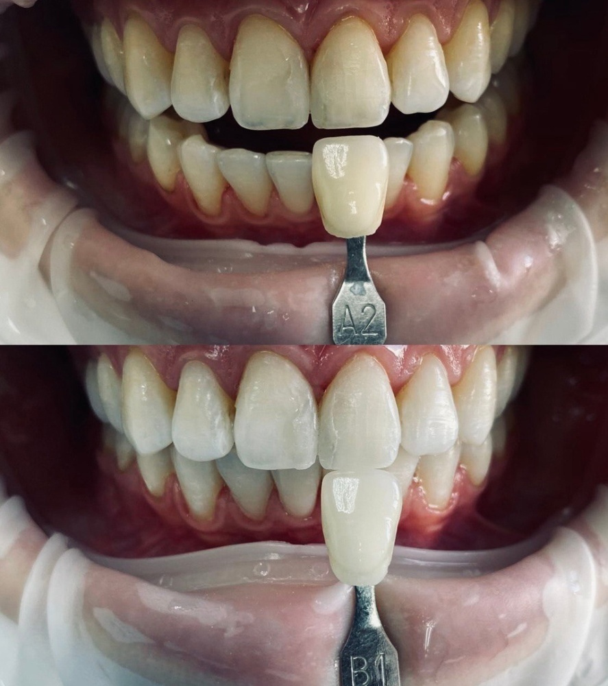 Многие задаются вопросом, безопасно ли отбеливание зубов, будет ли результат?